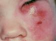 The common features in cellulitis, a skin and soft tissue infection, are redness, warmth, and swelling of the infected skin.