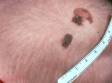 Moles (nevi) present at birth, made up of nests of pigment-producing cells, are known as congenital melanocytic nevi.