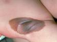 A congenital nevus is often quite large and dark brown, as in this childs armpit area.