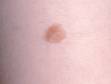 This image displays a close-up of a small congenital melanocytic nevus.