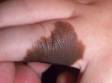A congenital melanocytic nevus (birthmark) usually has sharply defined edges and an even brown color.