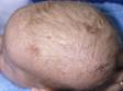This is a typical, mild case of cradle cap. There is scaling without any redness of the affected skin. 