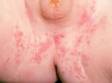 Scattered papules and pustules are typical in a diaper area candida infection (yeast infection).