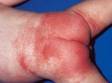 This image display bright red skin caused by persistent irritation.