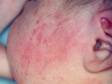 This infant with erythema toxicum neonatorum has scattered pink lesions typical of this rash.