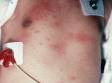 Tiny blisters (vesicles) and pimples (pustules) are typical of erythema toxicum neonatorum.