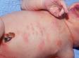 This newborn with erythema toxicum neonatorum has scattered areas of pimples (pustules) and pink skin.