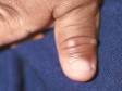 This image displays small blisters on the thumb of an infant with hand-foot-and-mouth disease.