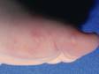 This image displays smooth-appearing blisters on the feet typical of hand-foot-and-mouth disease.