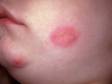 This image displays grouped blisters within an inflamed area of skin typical of herpes simplex.