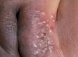 This image displays a 2 year old with primary herpes simplex involving the genital area.