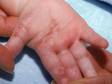 This image displays grouped blisters on the palm and fingers typical of a herpes virus infection.