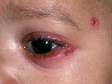 The herpes simplex virus can involve the eyelids and the cornea.