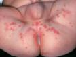 Small, grouped erosions, some of which are broken, display herpes simplex lesions in this infants diaper area.