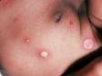 This image displays an unusual case of impetigo; typically, the pus-filled lesions break so easily, they leave eroded skin.