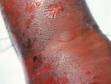 This image displays a large blister in the center and many erosions with crusts typical of impetigo.