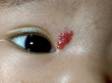 Strawberry red hemangiomas grow rapidly, and particularly those near the eye should be followed carefully by a dermatologist.