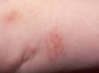 This is mild dermatitis of the forearm of an infant.
