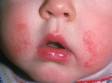 The cheeks are a frequent site of irritant contact dermatitis from constant wetting and drying.