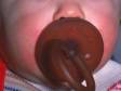 Constant drooling around this pacifier caused irritant contact dermatitis (skin inflammation).