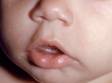 Milia are tiny cysts that occur for unknown reasons in infants.
