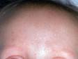 This image displays milia, the small, white bumps at the center of the forehead.