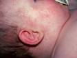In miliaria rubra, blocked sweat glands cause small, red skin bumps.