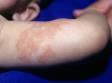 Port-wine stains are persistent vascular malformations, as seen here on the arm.