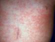 This image displays the rash of roseola (sixth disease) that follows a high fever.