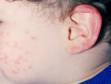 The rash of roseola (sixth disease) affect the face and ears of this infant.
