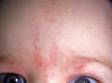 Salmon patches frequently occur at the center of the forehead.