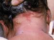 Salmon patches typically occur at the back of the neck.