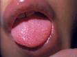 In scarlet fever, a "strawberry" appearing tongue is common.