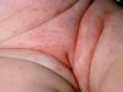 This image displays red, bumpy patches of seborrheic dermatitis on the diaper area of an infant.