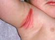 Seborrheic dermatitis often involves body folds, such as the armpits, in infants.