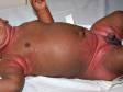 Seborrheic dermatitis frequently involves the diaper area and other body folds, as seen in this infant.