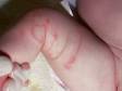 Urticaria (hives) can have pink, ring-like shapes.