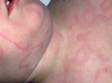 Urticaria (hives) often causes ring-like and curving line-like shapes.