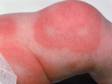 Urticaria (hives) can appear at any age, including in newborns.