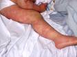 This image displays extensive urticaria (hives).