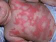 This image displays urticaria (hives), which can produce bizarre shapes.