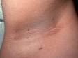 This image displays a skin fold with a rough, "velvety" appearance typical of acanthosis nigricans.