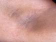 Acanthosis nigricans, most commonly, is noticed at the armpits and/or neck as a slightly thickened color change, which is sometimes described as appearing "velvety."