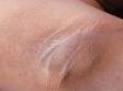 The darkened color and skin thickening is sometimes subtle in mild and early cases of acanthosis nigricans, as seen here.