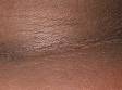 This image displays a close-up of the neck showing the typical velvety skin thickening seen in acanthosis nigricans.
