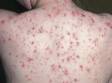Severe cystic acne on the back can leave permanent scars.