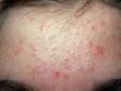 This patient has numerous whiteheads (closed comedones) as well as red, inflammatory acne bumps on the forehead.