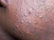 In Black patients, inflammatory lesions lead to unwanted dark spots, as displayed in this image.