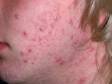 This image displays a mix of pus-filled and inflammatory acne.