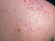 This image displays a mix of blackheads (open comedones), red bumps, and depressed scars typical of acne vulgaris.